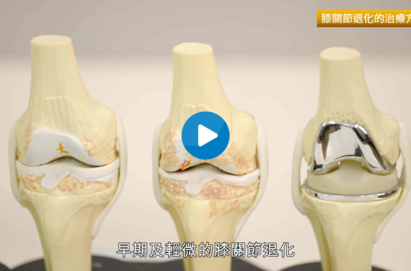 Dr Yan Knee Replacement