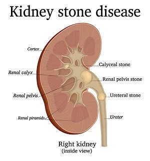 Kidney Stone Centre Gleneagles Hospital Hong Kong